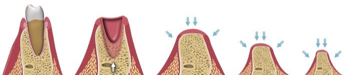 Bone Grafting